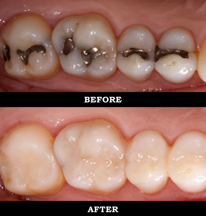 Tooth Color Filling Clinic